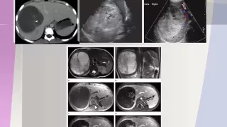 Imaging of Pediatric abdominal masses   Prof Dr  Hassan El Kiki In Arabic