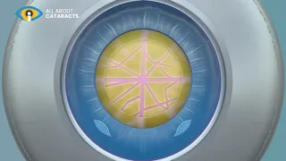 Cataract lens replacement surgery animation video
