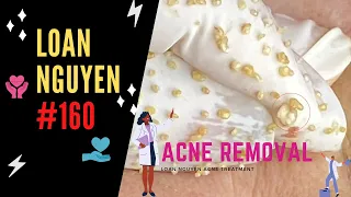 BEST BLACKHEADS EXTRACTION AND WHITEHEADS (160) | Loan Nguyen