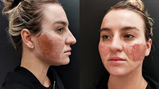 Acne Scar Removal with CO2 Laser Treatment - Before & After