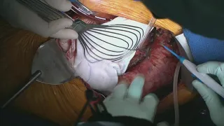 Total arch and descending aortic repair through left thoracotomy for the chronic Type A dissection