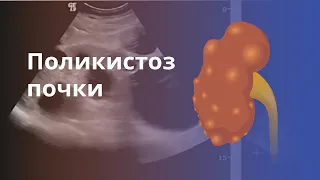 Поликистоз почек. Причина, диагностика и лечение. Критерии УЗИ