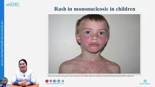 Infectious mononucleosis in children