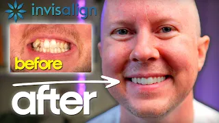Invisalign Review + Before & After - I'm Happy With the Results BUT....