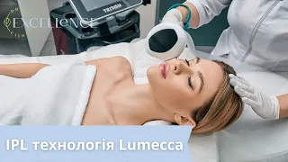 IPL Lumecca || Видалення пігментації || Лікування куперозу та розацеа || Фотоомолодження IPL