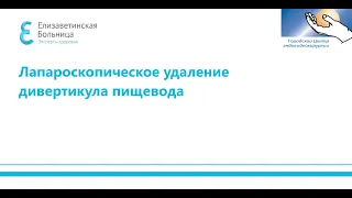 Лапароскопическое удаление дивертикула пищевода