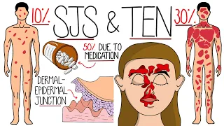 Understanding Stevens-Johnson Syndrome and Toxic Epidermal Necrolysis (SJS & TEN)