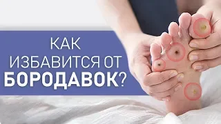 Как УДАЛИТЬ подошвенные БОРОДАВКИ. Причины появления и лечение. Советы дерматолога.