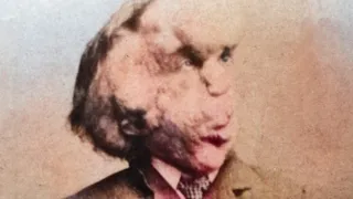 How The Elephant Man, Joseph Merrick, Really Died