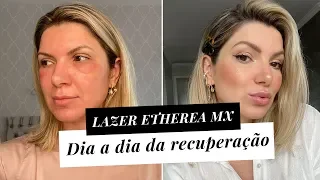 Fiz o Etherea MX - Melhor Laser Para Rejuvenescimento| Deusa Constanzi