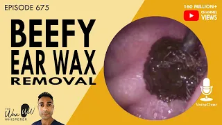 675 - Beefy Ear Wax Removal