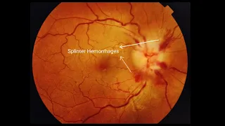 Papilledema; Bilateral Disc Swelling