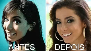 35 Famosos Antes e Depois da Plástica