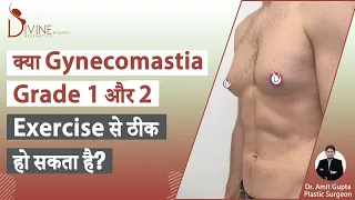 क्या Gynecomastia Grade 1 और 2 Exercise से ठीक हो सकता है? Gynecomastia treatment without surgery?