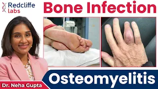 💹 What is Osteomyelitis? Osteomyelitis (Bone Infection) Symptoms, Causes And Treatment | Redcliffe