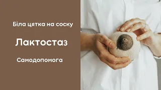 Лактостаз. Застій молока. Закупорка молочних проток. Біла цятка на соску. Блеб. Самодопомога.