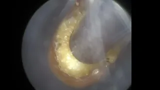 48 - Wet Impacted Ear Wax & Dead Skin on Eardrum Removed using the WAXscope®️