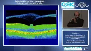 OCT en alteraciones de interfase vitreoretiniana (MER, AM, STVM) - Dr. Juan Manuel Jiménez Sierra