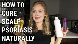 How to Cure Scalp Psoriasis Naturally | 5 Years After Shaving My Head