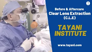 Before & After Clear Lens Extraction (CLE) | Tayani Institute