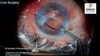 Corneal opacity Live surgery from Nandadeep Eye Hospital Dr Sourabh Patwardhan