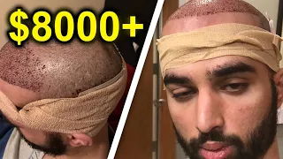 I GOT MY HAIR TRANSPLANT AT AGE 21 ($8000)