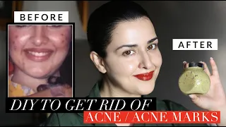 DIY TO GET RID OF ACNE & ACNE MARKS | SECRET SKINCARE INGREDIENT ALERT!