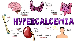 An Approach to Hypercalcemia - Causes, Calcium Homeostasis, Mechanisms & Signs and Symptoms Mnemonic