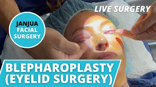 JOURNEY OF A BLEPHAROPLASTY (LIVE SURGERY) - DR. TANVEER JANJUA - NEW JERSEY