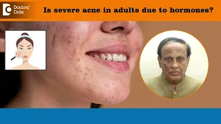 SEVERE ACNE IN ADULTS - Is it Hormonal? Know more from Expert - Dr. D A Satish | Doctors’ Circle