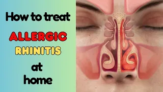 Allergic rhinitis (hay fever), symptoms, home remedies, natural remedies, homeopathic remedies