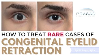 How Genetic Upper and Lower Eyelid Retraction can be Treated Surgically