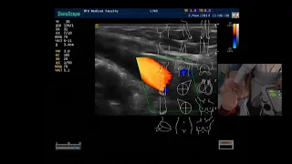Ультразвуковая анатомия сосудов шеи