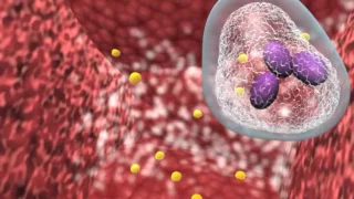 Bacterial infection and host response.