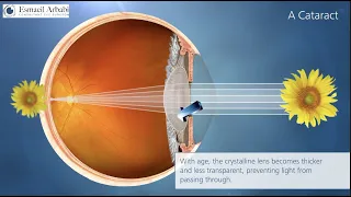 What is Cataract? Animation high quality video