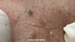 Popping Tons Of Blackheads Part 226