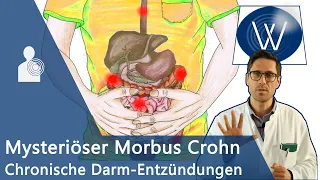 Morbus Crohn: Ursache für unblutigen Durchfall & Bauchschmerz? Chronisch-entzündliche Darmerkrankung