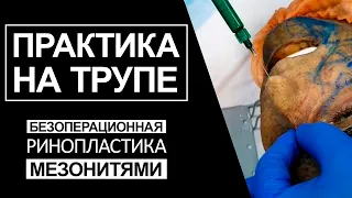 Безоперационная ринопластика мезонитями - практика на трупе