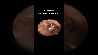 BIGGEST Earwax Removal #earwaxremoval #doctoranh