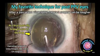 CataractCoach™ 1913: my favorite technique for post PPV eyes