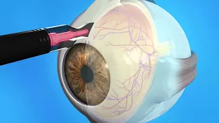 Хирургия глаукомы  (Glaucoma Surgery) - 14
