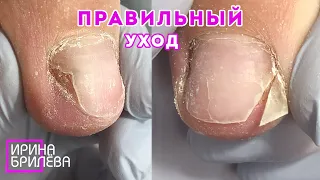 ПЕДИКЮР 👍 Обработка пальцев ног с ОНИХОЛИЗИСОМ 🌸 Правильный уход за ногтями