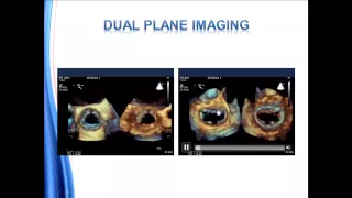 Guidelines for Performing a Comprehensive Transesophageal Echocardiographic Examination