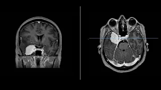 Cavernous Sinus - Lateral Wall  Meningioma