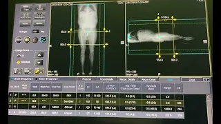 طريقه تصوير الشريان الاورطي وشرايين الطرفين Angiography Both Lower Limb From Aortic Arch To Foot