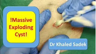 Massive 20 year Cyst Explosion. LipomaCyst.Com Dr Khaled Sadek