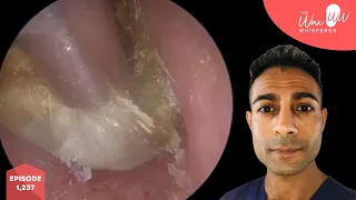 1,237 - Massive Amounts of Ear Wax Removal