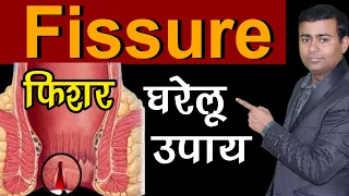 फिशर के घरेलु उपाय  I Permanent Treatment of Fissure I fissure ka ilaj hindi