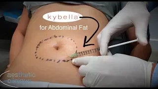 Kybella for Abdominal Fat