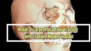 Repair of Large Orbital Floor Fracture with Titanium Medpor Implant